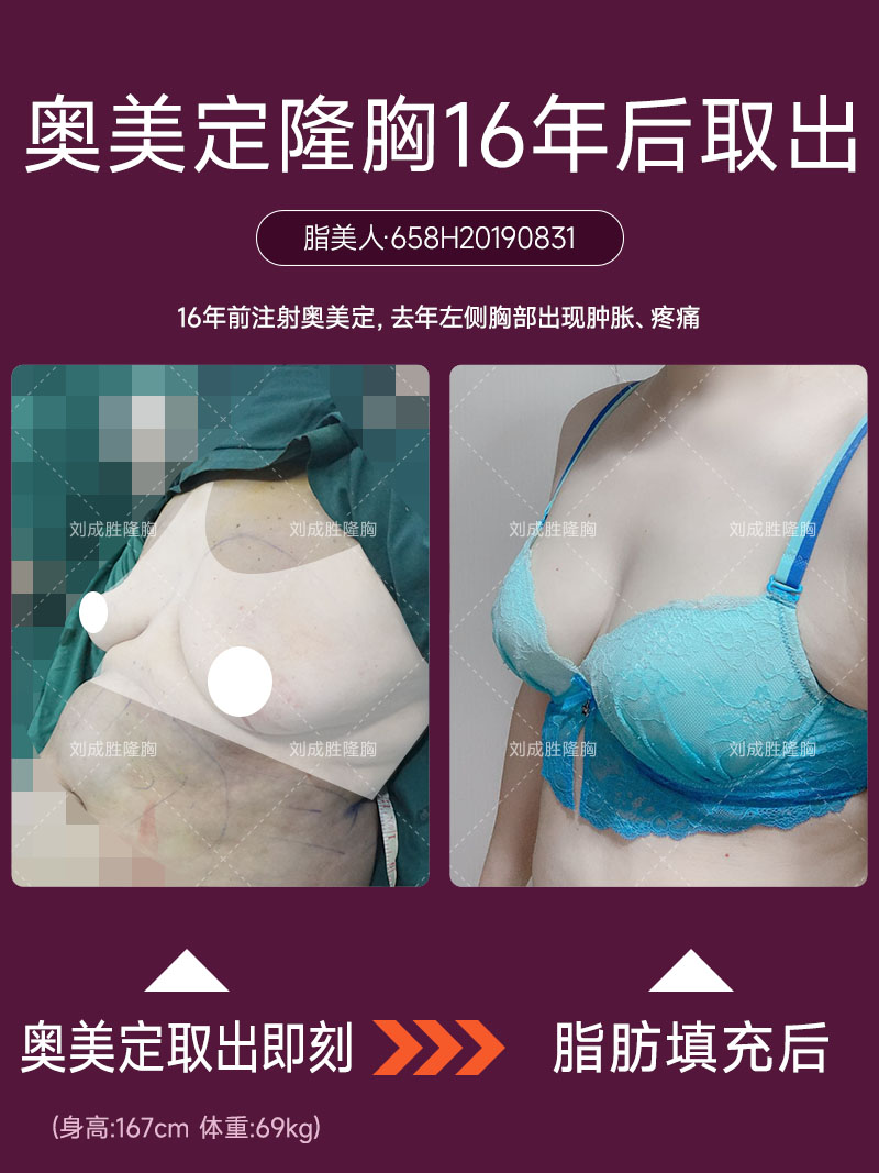 奥美定取出后多长时间适合植入假体：详细解析